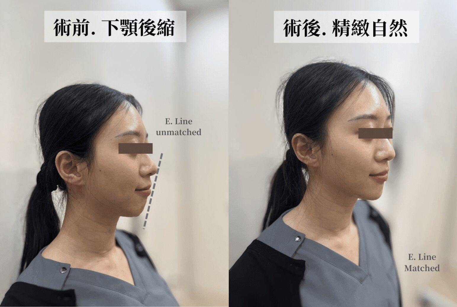下顎線不明顯怎麼辦？3種下顎線醫美打造完美側臉
